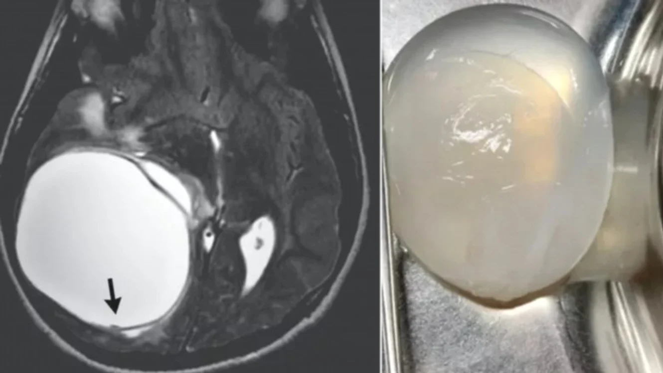 Copil diagnosticat cu tumoare pe creier / Foto: The New England Journal Of Medicine